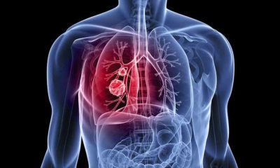 καρκίνος του πνευμονα